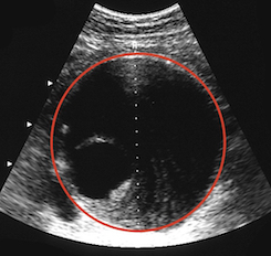 Bauchaortenaneurysma Screening