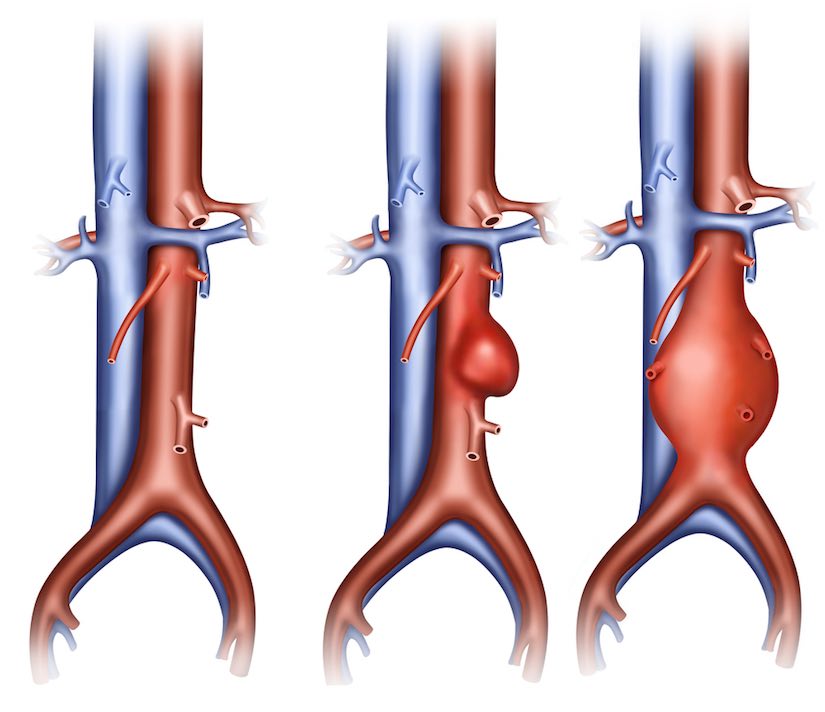 Bauchaortenaneurysma