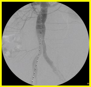 Bauchaortenaneurysma – Gefäßchirurgie Berlin