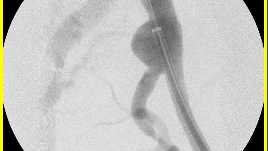 Aneurysma-iliakal-IBD