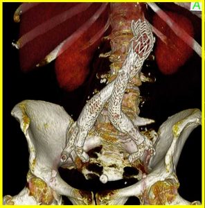 Rupturiertes-Bauchaortenaneurysma-EVAR-und-IBD